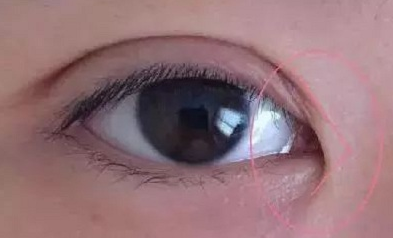 開眼角手術價格要多少錢？