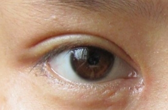 開(kāi)眼角手術(shù)后會(huì)不會(huì)留疤？