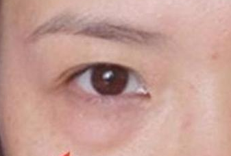 光纖溶脂去眼袋手術有哪些優(yōu)勢？