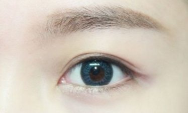 開眼角需要注意的事項(xiàng)有哪些？