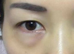 光纖溶脂去眼袋術后如何護理？