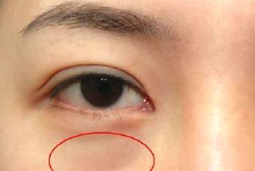 光纖溶脂祛眼袋需要多少錢(qián)？光纖溶脂怎么樣呢？
