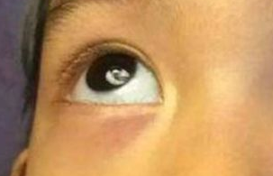 激光祛眼袋需要多少錢？