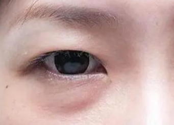 激光祛眼袋有用嗎？