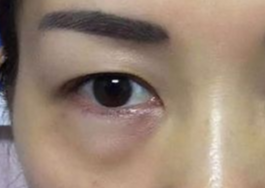 激光可以祛眼袋嗎？激光祛眼袋有哪些副作用？