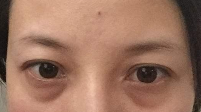 激光祛除眼袋有效嗎？激光祛眼袋有什么利弊？