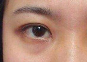 去眼袋是激光好還是內(nèi)切好？激光祛眼袋是什么原理？