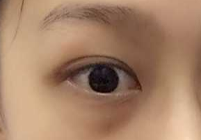 激光祛眼袋要多少錢？