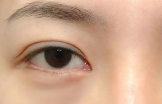 激光去眼袋多久做一次？