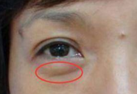 激光去眼袋可以管多久？激光祛眼袋多久可以恢復(fù)？