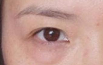 激光去除眼袋后遺癥有哪些？