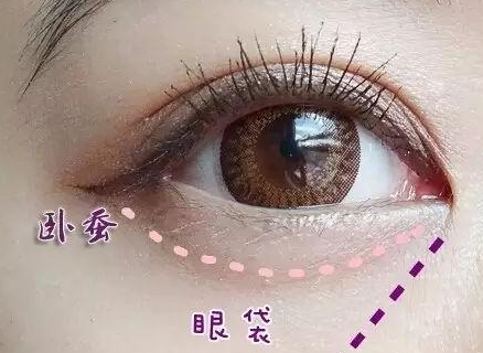 激光消除眼袋怎么樣？激光溶脂去眼袋多少錢？