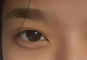 激光去眼袋后需多久能恢復(fù)？激光去眼袋快速有效嗎？