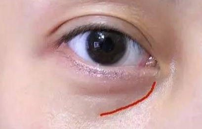激光去眼袋手術(shù)費(fèi)用是多少？