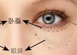 激光祛眼袋多久才能恢復(fù)？