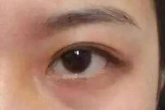 激光祛眼袋效果真的好嗎？激光去眼袋會(huì)有風(fēng)險(xiǎn)嗎？