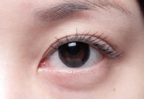 激光去眼袋會不會很疼？激光去眼袋什么人適合？