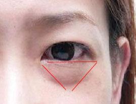激光除眼袋效果如何？激光去眼袋要注意什么？