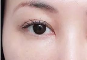 激光去眼袋什么人適合？