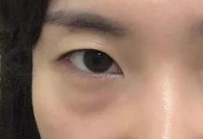 激光祛眼袋會(huì)疼嗎？激光去眼袋手術(shù)好嗎？