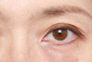激光去眼袋幾天能恢復？激光去眼袋是怎樣的？