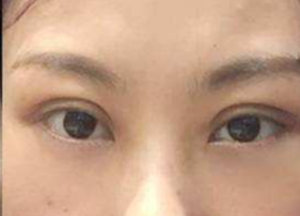 激光去眼袋可保持多久？激光去除眼袋效果好不好？