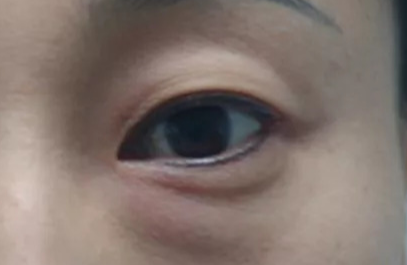 激光去除眼袋效果好不好？