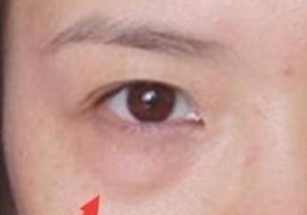 激光去眼袋的效果怎么樣？激光去眼袋注意事項有哪些？