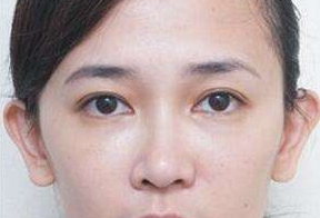 激光去眼袋后要休息多久呢？激光去眼袋會(huì)很痛嗎？