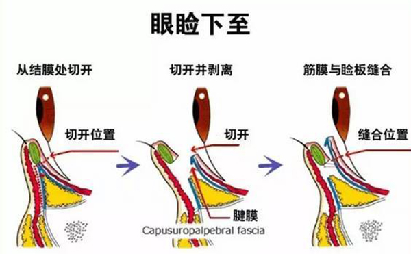 開外眼角和眼瞼下至的區(qū)別是什么?多久恢復好?