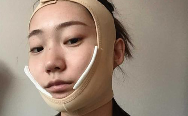 下頜角形術后注意事項