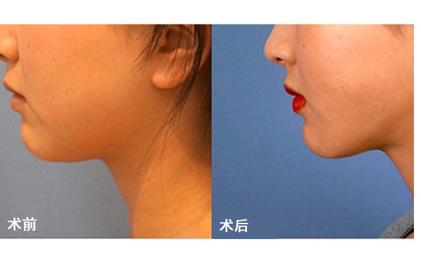 面部吸脂后皮膚會不會松弛？