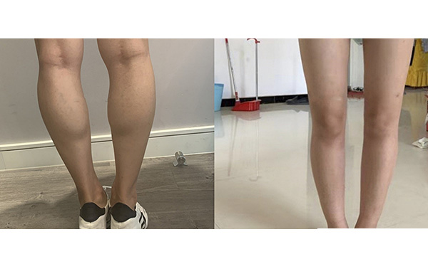瘦腿針和吸脂哪個(gè)好？