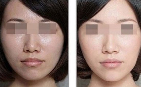 美白針的效果怎么樣？