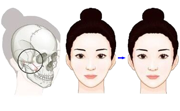 顴骨降低整形手術(shù)是怎么操作的？有什么特點(diǎn)？