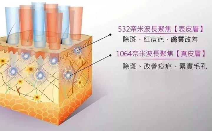 皮秒祛斑恢復(fù)期多久？