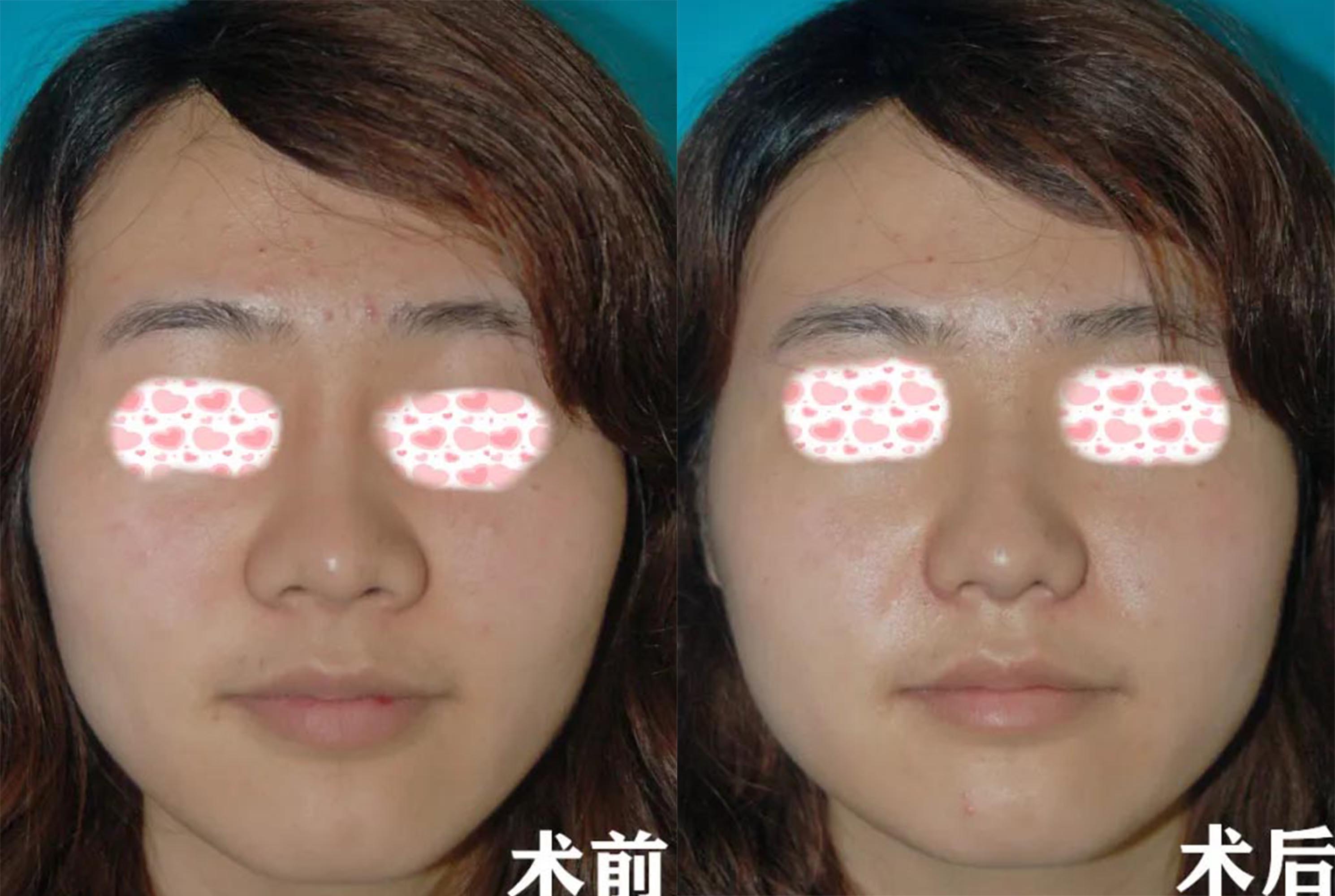 北京玉之光做鼻頭縮小術(shù)前術(shù)后效果對(duì)比