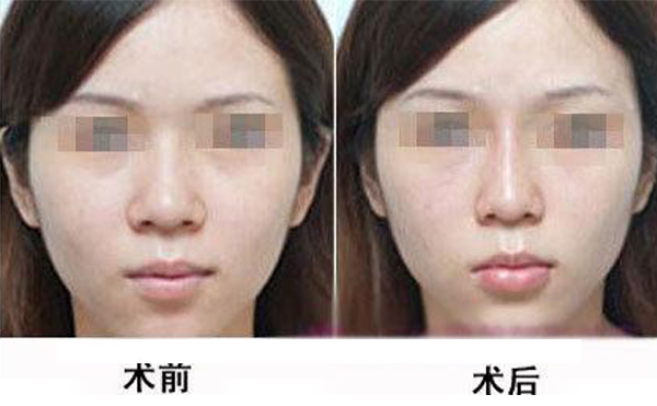鼻頭縮小手術(shù)是怎么做的？術(shù)后應(yīng)該怎么護(hù)理