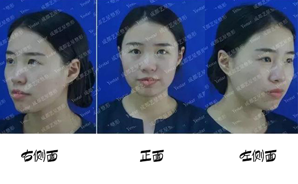 福州名韓整形改善蒜頭鼻大概要花多少錢？