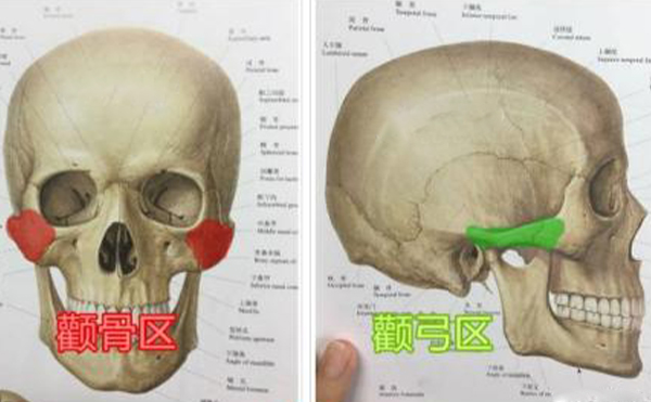 顴骨整形手術(shù)多久能消腫？