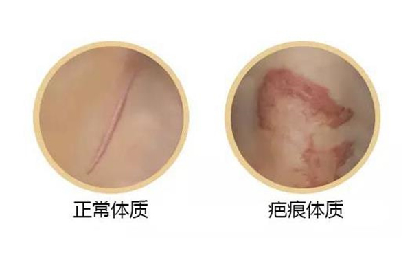 疤痕體質(zhì)割雙眼皮怎么樣?如何自測(cè)疤痕體質(zhì)?