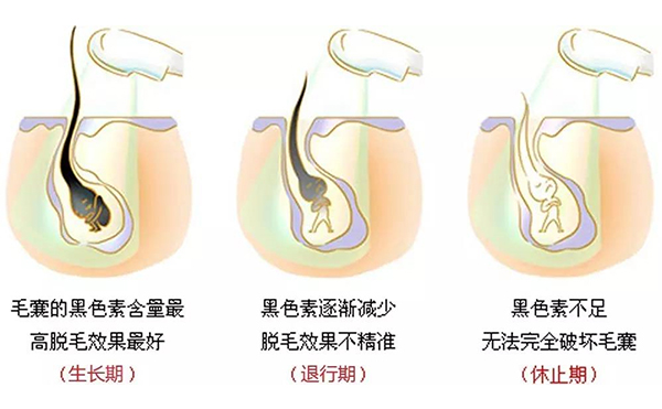 冰點脫毛