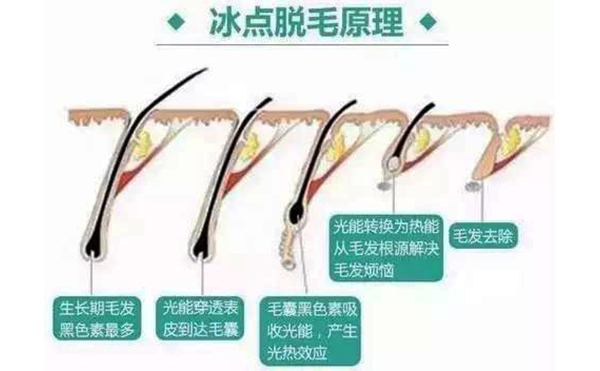 脫毛方法有哪些?都有什么區(qū)別?