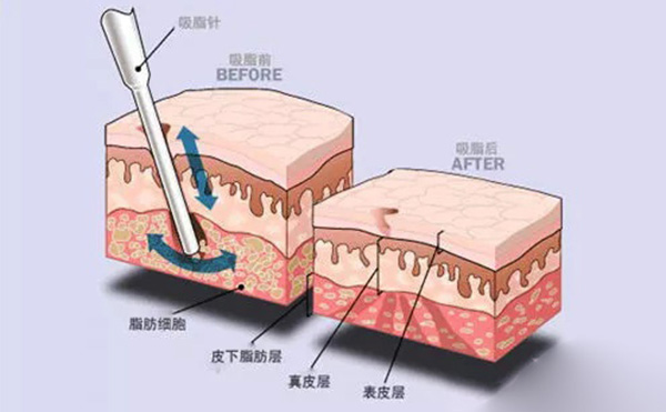 吸脂和溶脂有什么區(qū)別?哪個效果好?