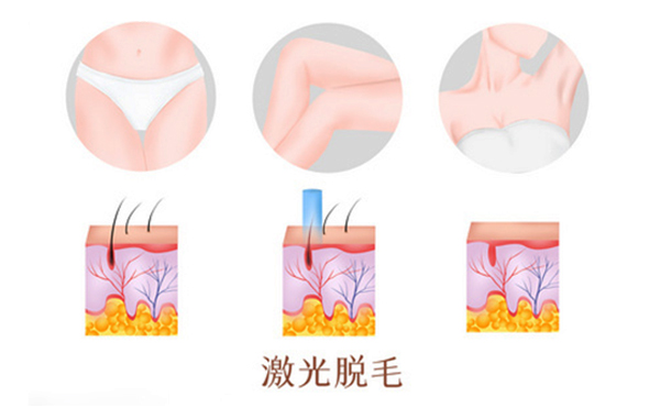 脫毛方法有哪些?都有什么區(qū)別?