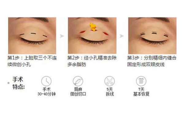 韓式三點雙眼皮的手術過程是什么?術后怎么避免疤痕增生?