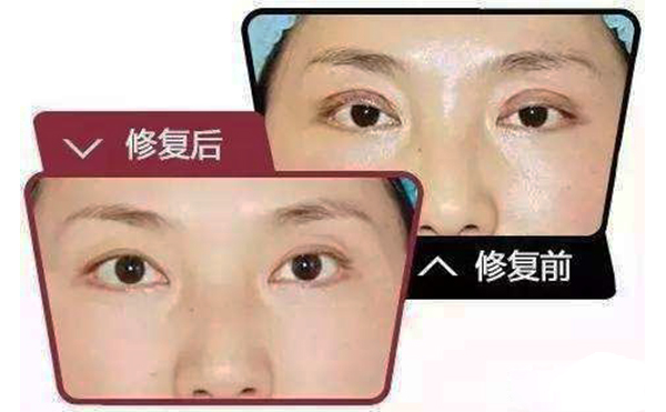 哪些情況需做雙眼皮修復(fù)？修復(fù)難度大不大?