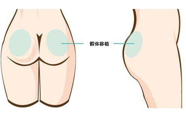 假體豐臀有副作用嗎?術(shù)后會(huì)不會(huì)留疤?