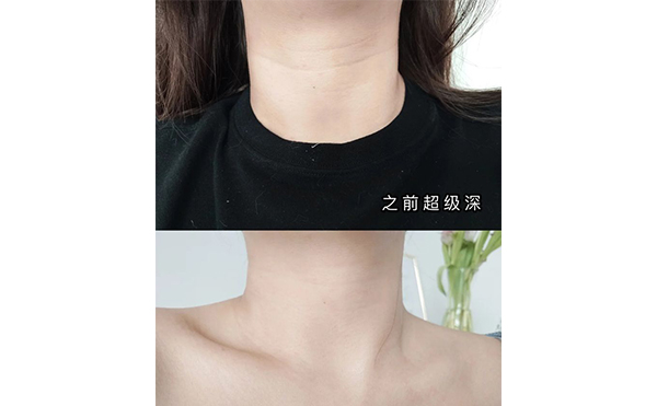 激光去頸紋適合哪些人？