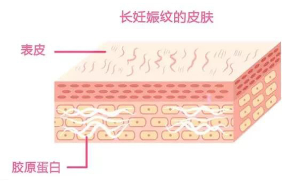 妊娠紋是怎么形成的？